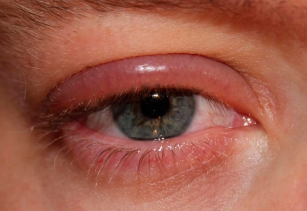 Заболевания кожи вокруг глаз и век. Диагностика и лечение